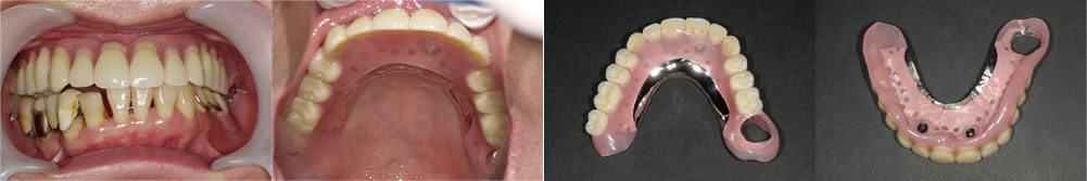 当院で実施した50代女性の入れ歯治療：ケース①